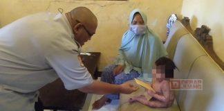 Kader Banteng Kabupaten Tegal Bantu Balita yang Kulitnya Melepuh Sekujur Tubuh