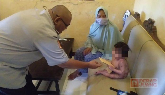 Kader Banteng Kabupaten Tegal Bantu Balita yang Kulitnya Melepuh Sekujur Tubuh